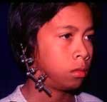 การเพิ่มขนาดขากรรไกรล่างด้วยอุปกรณ์ดึงยืดขยายกระดูก distraction osteogenesis